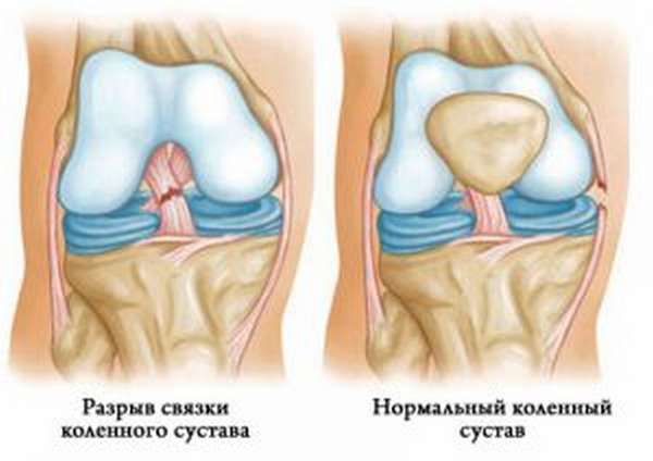 Артроскопия сустава колена